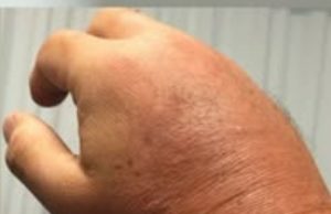 Foods That Help Reduce Swollen Hands or Feet