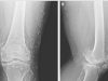 X-Ray Reveals Hundreds of Gold Needles in Woman’s Knees